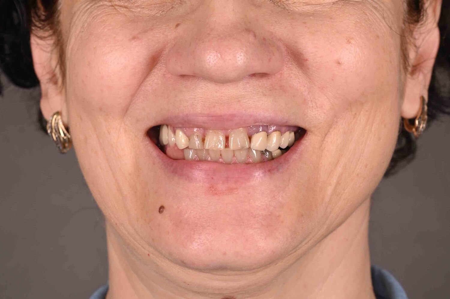 Pacient Clinica Dr. Alin Odor - Rezultat Implantologie
